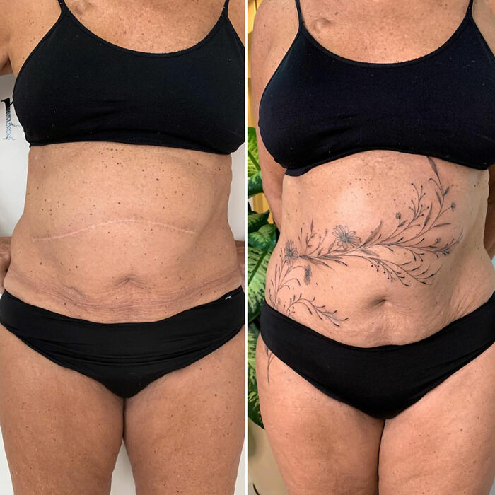 Before and after of a scar transformed into a floral tattoo, showcasing an artist's skill in enhancing confidence.
