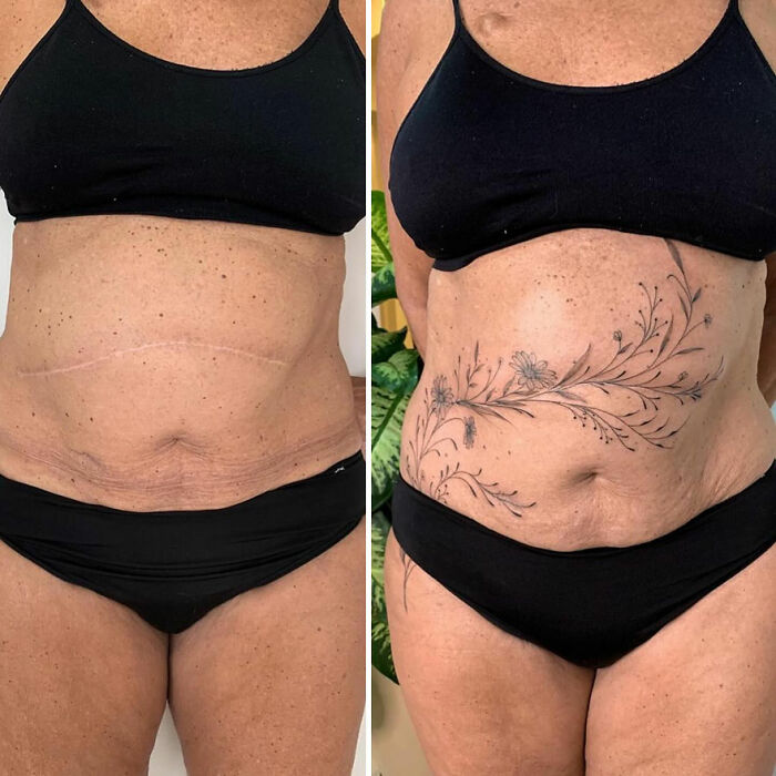 Before and after tattoo transformation turning scars into beautiful body art on a woman's abdomen.