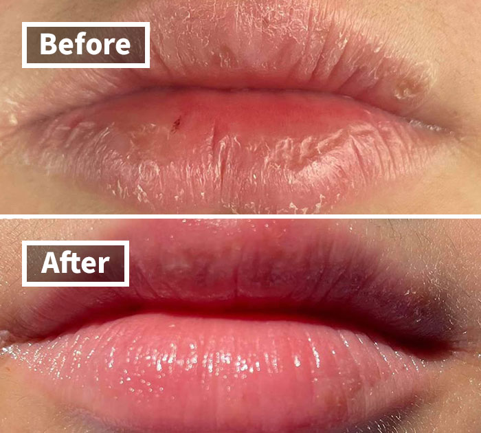 "Lip transformation before and after; dry to moisturized lips essential for spring function."