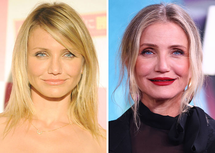 Side-by-side photos of a woman illustrating changes possibly related to plastic surgery regret.