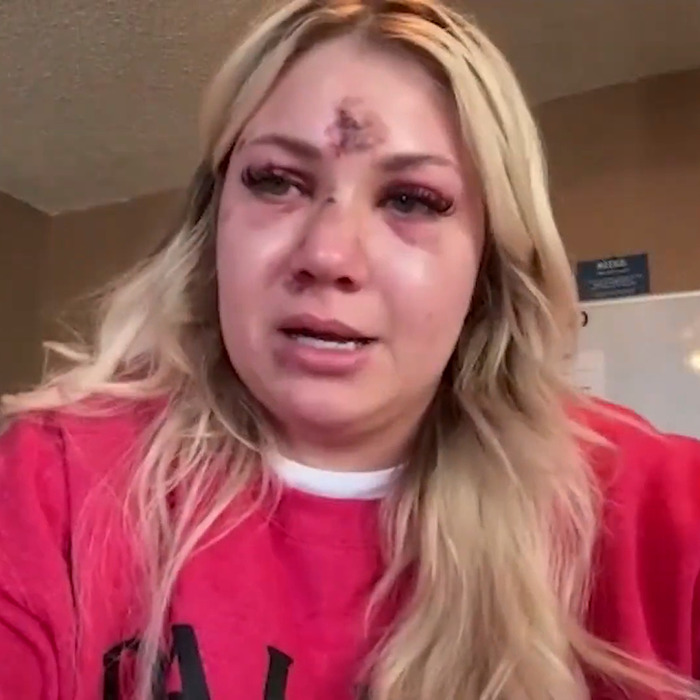 Bride-to-be with injuries, wearing pink, after assault at bachelorette party.