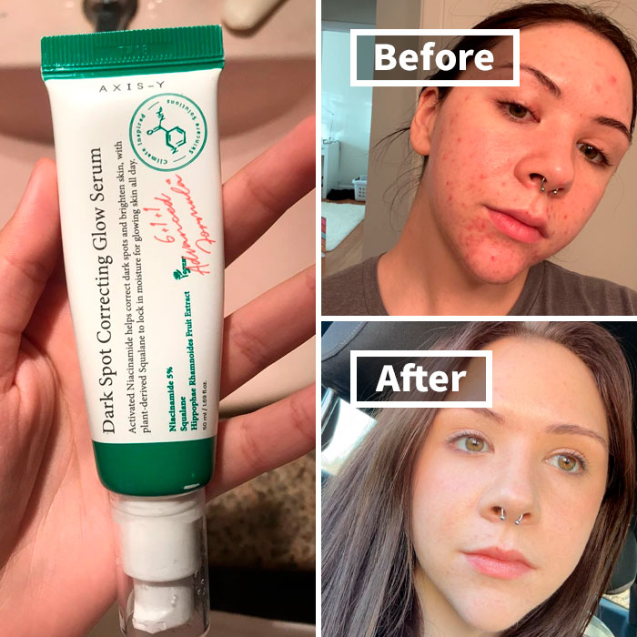 Dark Spot Correcting Glow Serum with before and after acne treatment results.