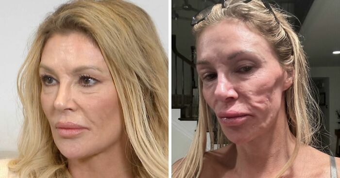 Brandi Glanville Says Her Face Has ‘Literally Melted Away’ Amid ‘Worse Than Ever’ Disfigurement