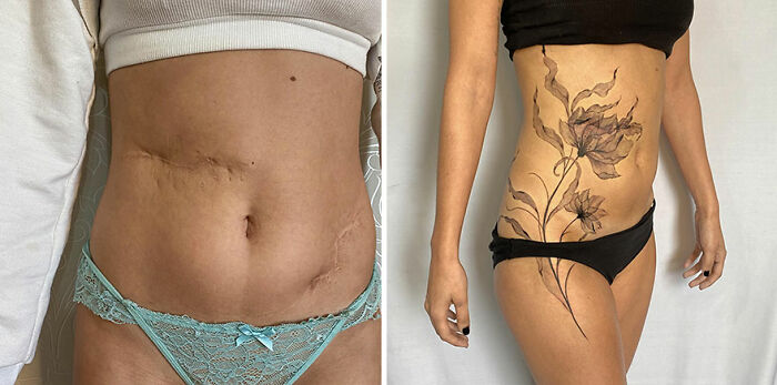 Before and after of a scar transformed into a floral tattoo, enhancing body confidence.