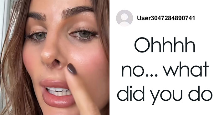 “See The Potential”: Woman Brutally Trolled After Rhinoplasty Defends The Results