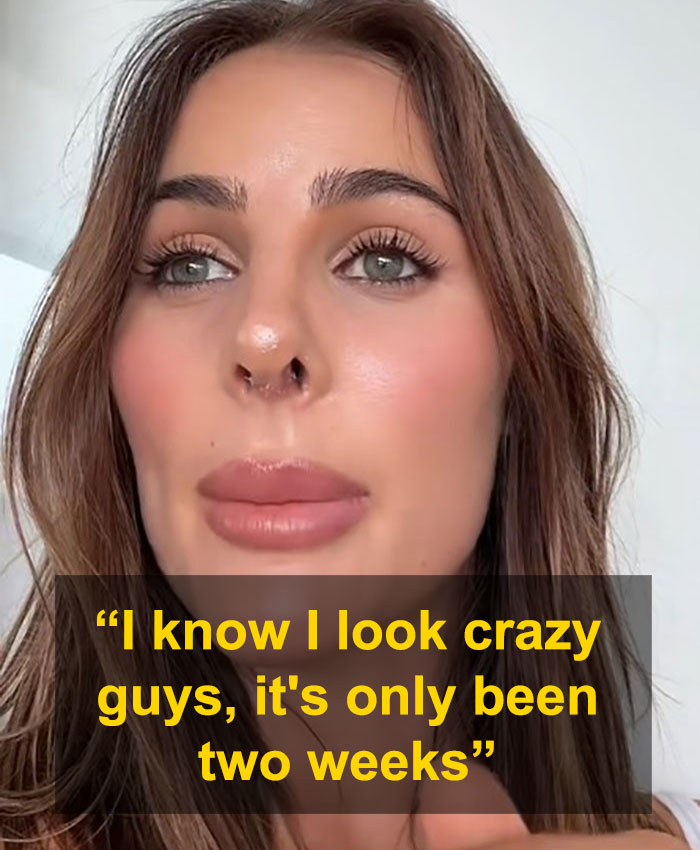Woman discusses rhinoplasty results amidst online trolling.