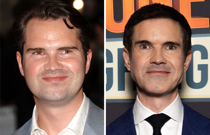 Comedian discusses cosmetic "tweakments" in side-by-side photos, showcasing changes over time.