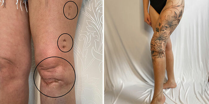 Scar covered with a floral tattoo, showing transformation in confidence through beautiful art.