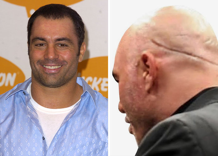 A person before and after plastic surgery, highlighting celebrity regret over cosmetic changes.