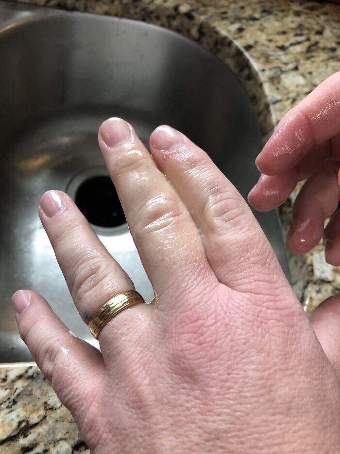 Close-up of a hand with a wedding ring stuck on a swollen finger over a kitchen sink, highlighting an "idiot" moment.