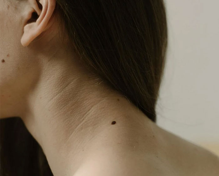 Person's neck with a mole, possibly resembling a scene accidentally shared on social media.