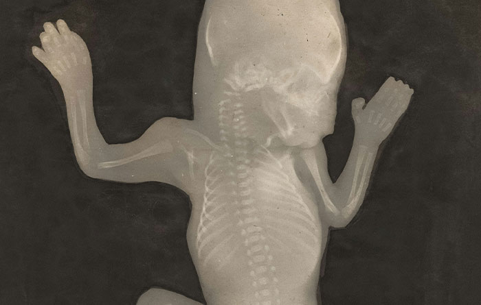 X-ray image of an infant skeleton, illustrating a disturbing fact about early development and anatomy.