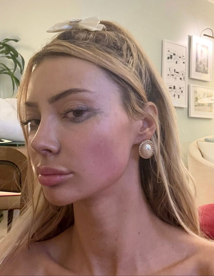 Woman with facial bruising and pearl earrings, related to outrage over lawyer's comment on injury. Woman with facial bruising and pearl earrings, related to outrage over lawyer's comment on injury.