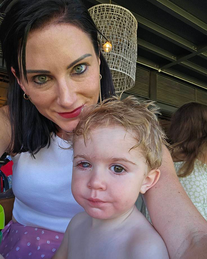 Woman holding toddler with eye condition from herpes virus in a casual setting. Woman holding toddler with eye condition from herpes virus in a casual setting.