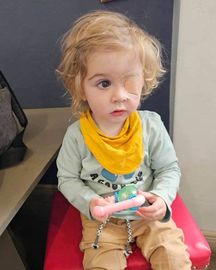 Toddler with an eye patch, seated, wearing a yellow bib and holding a toy, affected by the herpes virus. Toddler with an eye patch, seated, wearing a yellow bib and holding a toy, affected by the herpes virus.