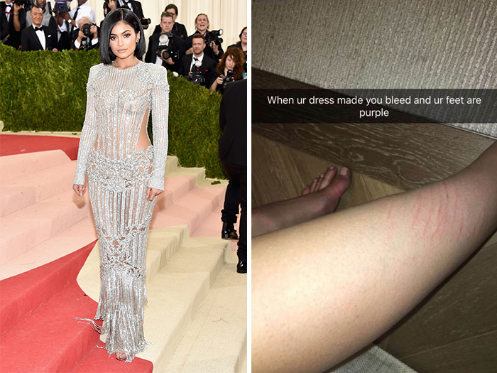 Celebrity in a silver gown on the red carpet; image of leg with marks from wearing the dress, illustrating fashion challenges.