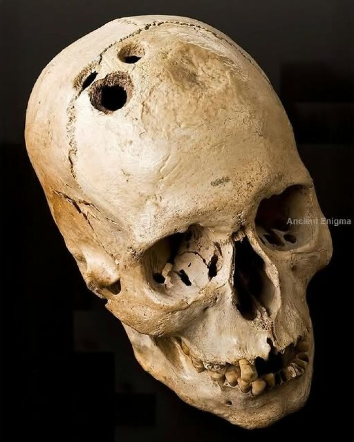 Elongated ancient human skull with visible drill holes, featured in archaeology news and architecture discoveries.