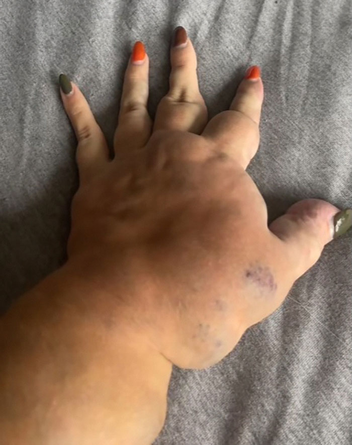 Woman's hand with one arm visibly larger, showcasing beauty in uniqueness.