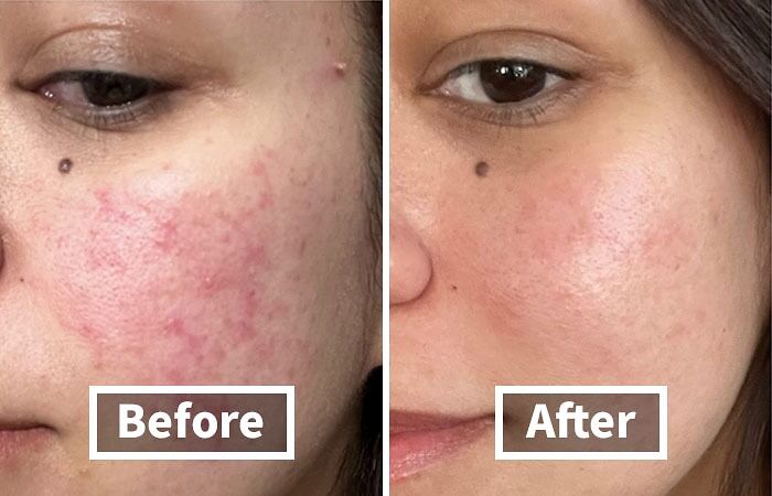 "Before and after images showing reduced facial redness, making life slightly less hard."