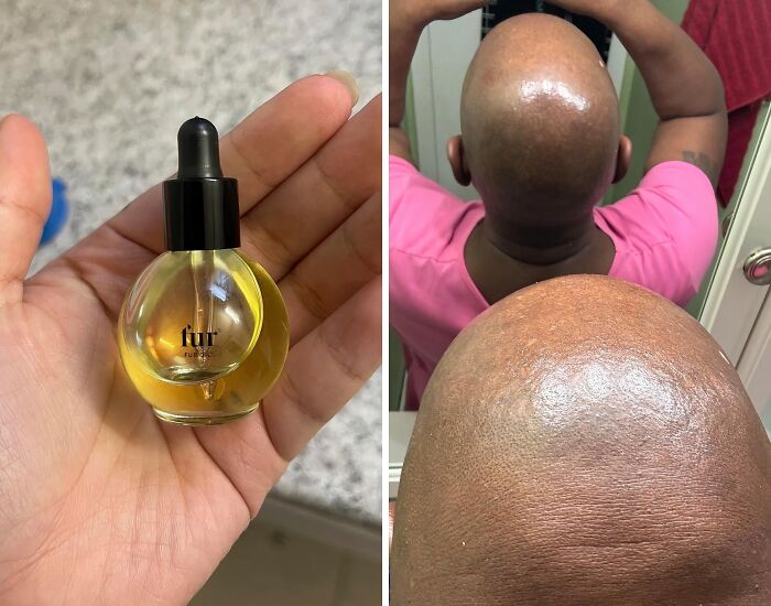 Oil in hand and shiny bald head, showcasing common body problems.