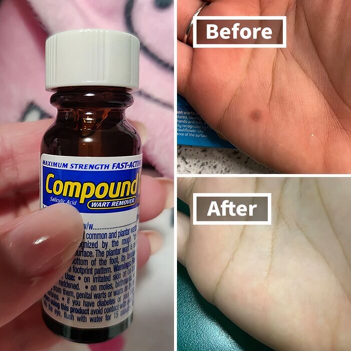 Wart removal process with Compound W, showing hand before and after treatment of common body problem.