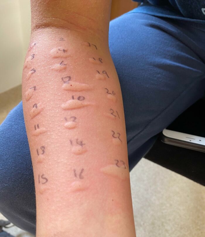 Brazo con múltiples marcas de picaduras numeradas, mostrando reacciones alérgicas dolorosas, personas con mal día.