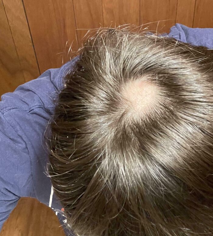 Bald spot on top of a person's head, highlighting a bad hair day.