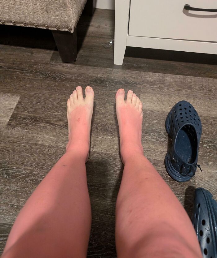 Sunburned feet contrasting with pale skin, sandals on the floor, showcasing a challenging day.