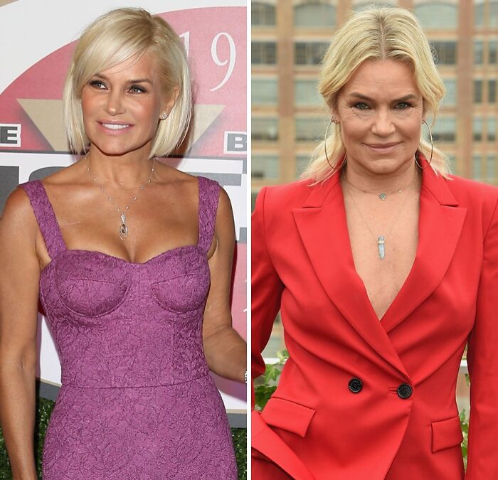 Side-by-side photo of a celebrity before and after breast implant removal, wearing a purple dress and red suit.
