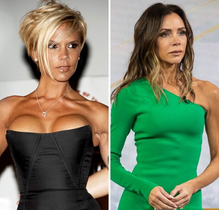 Two side-by-side photos showing a celebrity before and after breast implant removal.