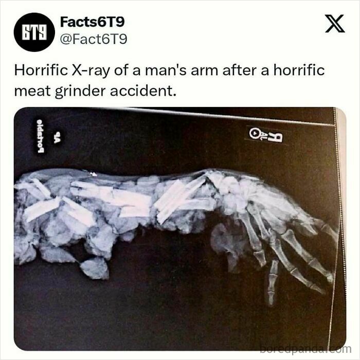 X-ray of a severely injured arm after a meat grinder accident, sparking interest in human and animal domestication.