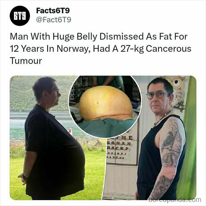 Man with large belly misdiagnosed for 12 years in Norway; later found to have a 27-kg tumor.