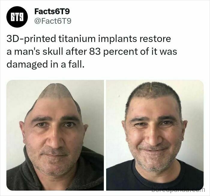Man with a reconstructed skull using 3D-printed titanium implants, showcasing a before and after transformation.