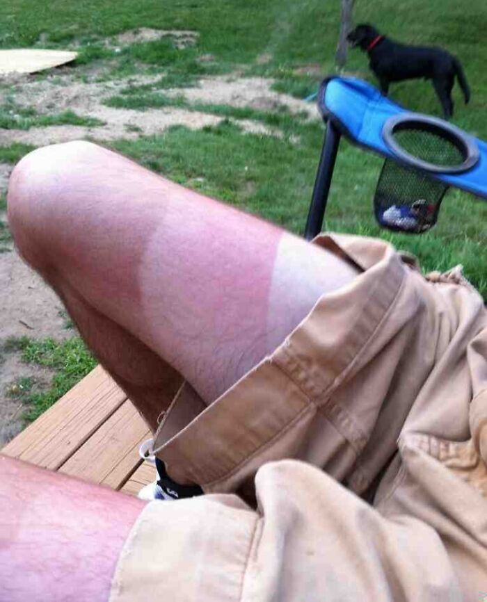 Close-up of sunburned legs with shorts, showing a sharp tan line, illustrating a worse day experience.