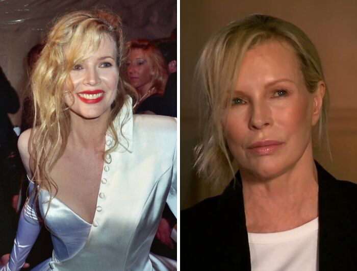 Celebrity before and after plastic surgery comparison showing facial changes and transformations over time.