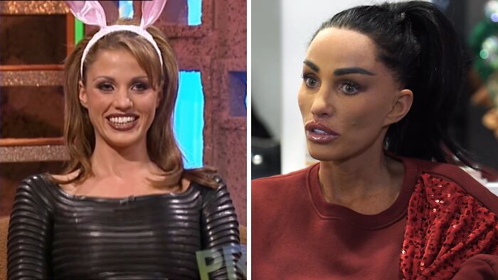 Side-by-side comparison of a celebrity before and after plastic surgery, highlighting dramatic facial changes.