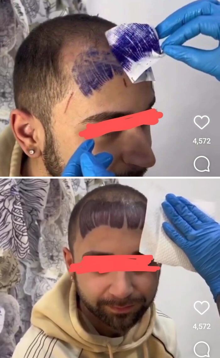 Man with a wild tattoo fail of a poorly done hairline tattoo on his forehead being cleaned by a gloved hand.