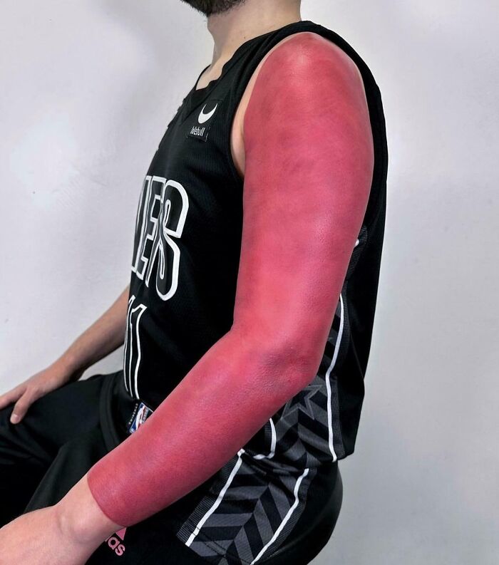 Man with a wild tattoo fail showing a full red arm sleeve that looks like a severe skin irritation or burn.