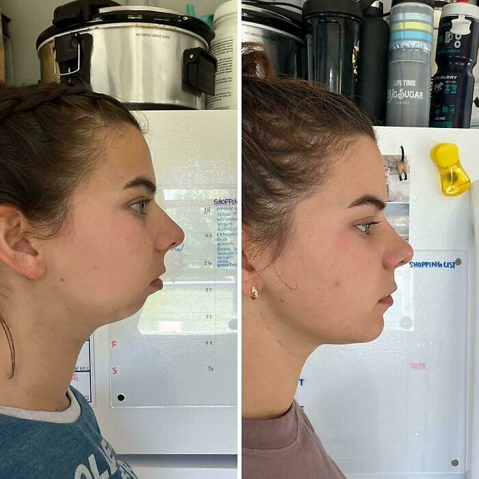 Side-by-side profile photos of a woman showing small appearance changes with noticeable facial contour improvement.