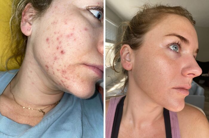 Side-by-side comparison of a woman's facial skin showing small appearance changes with improved complexion and reduced acne.
