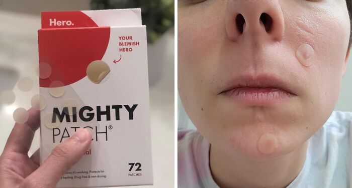 Hand holding a box of Mighty Patch with acne patches applied on a person's face for blemish treatment.