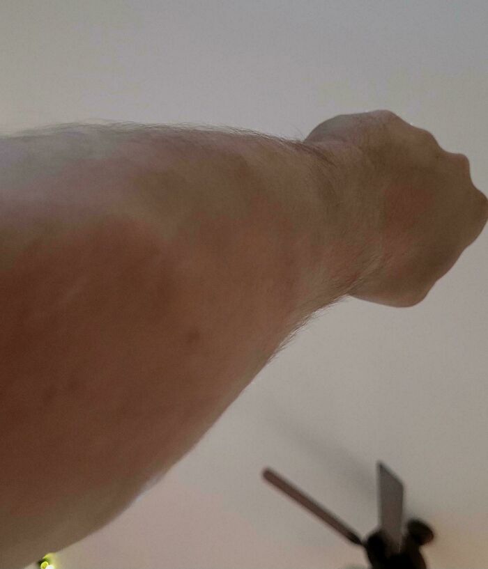 Close-up of an arm with a noticeable rash, illustrating current life in the US through the eyes of Americans.