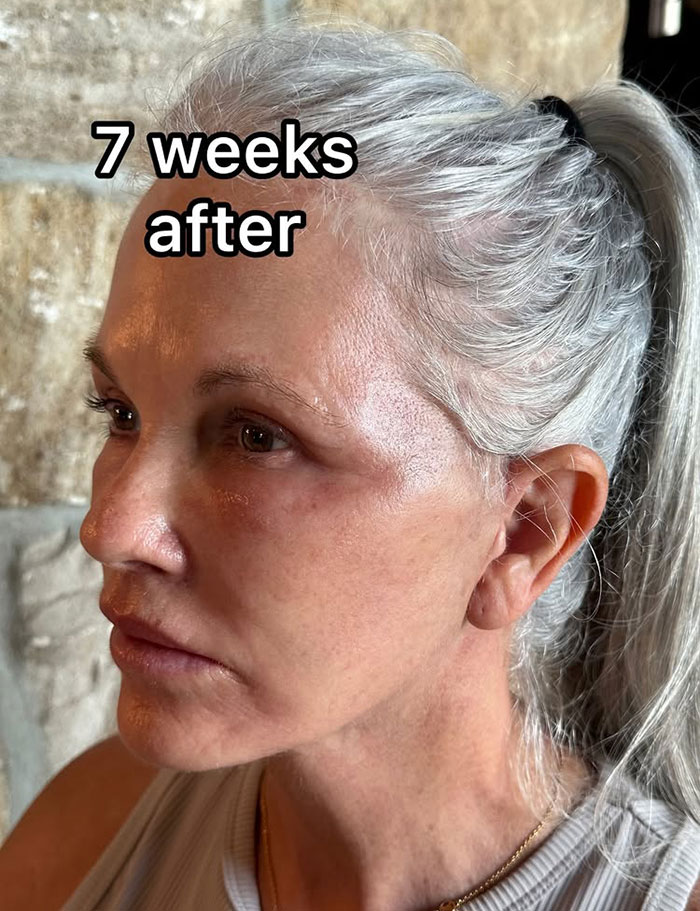 66-year-old woman 7 weeks after successful plastic surgery transformation. 66-year-old woman 7 weeks after successful plastic surgery transformation.