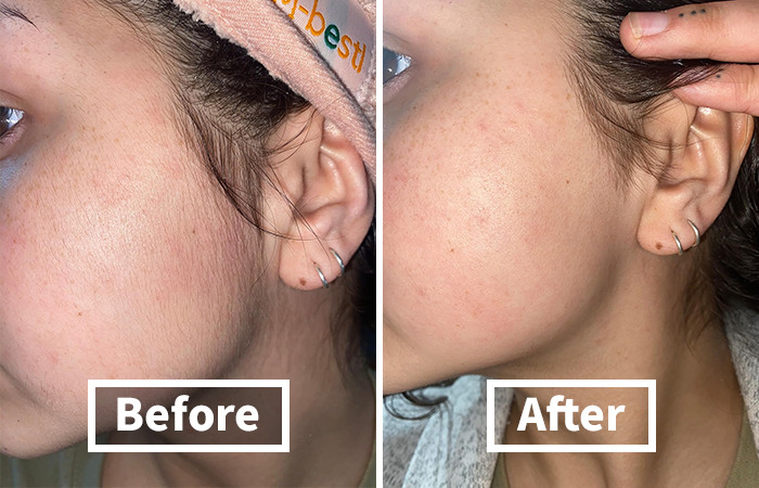 Before and after skin improvement, showcasing the perfect skincare purchase.