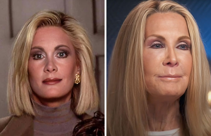 Side-by-side comparison of a celebrity before and after plastic surgery showing differences in facial features and appearance.