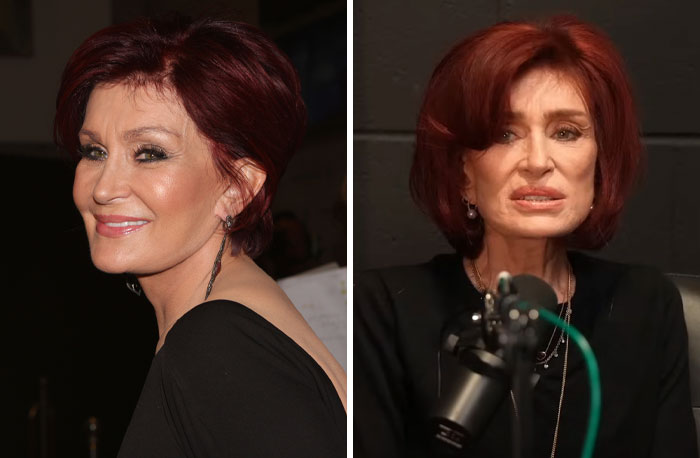 Side-by-side comparison of a female celebrity before and after plastic surgery showing noticeable facial changes and expressions.