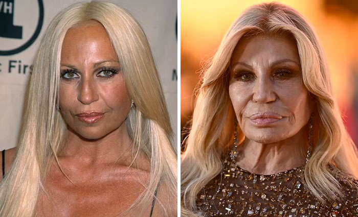 Celebrity before and after plastic surgery comparison showing changes in facial features and appearance over time.