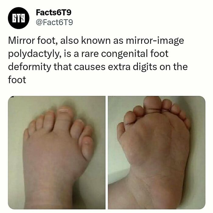 A foot with mirror-image polydactyly, showing extra toes, illustrating a rare congenital deformity.