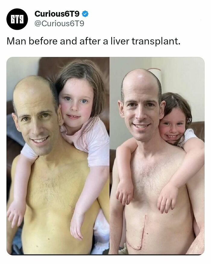 Man with a young girl before and after liver transplant, showing recovery.
