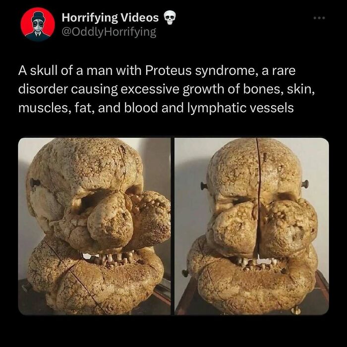 Oddly horrifying skull with Proteus syndrome, showing excessive bone and tissue growth, creating an unnerving appearance.